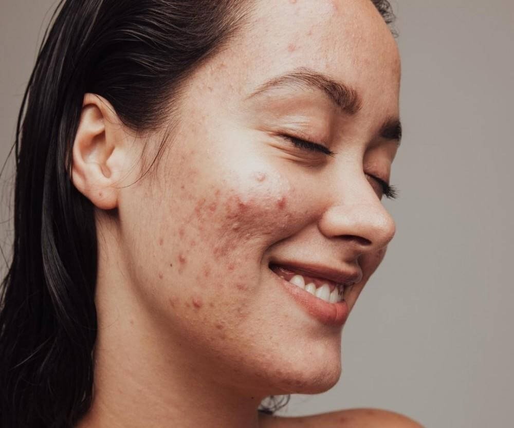 What You Need to Know About Menopausal Acne
